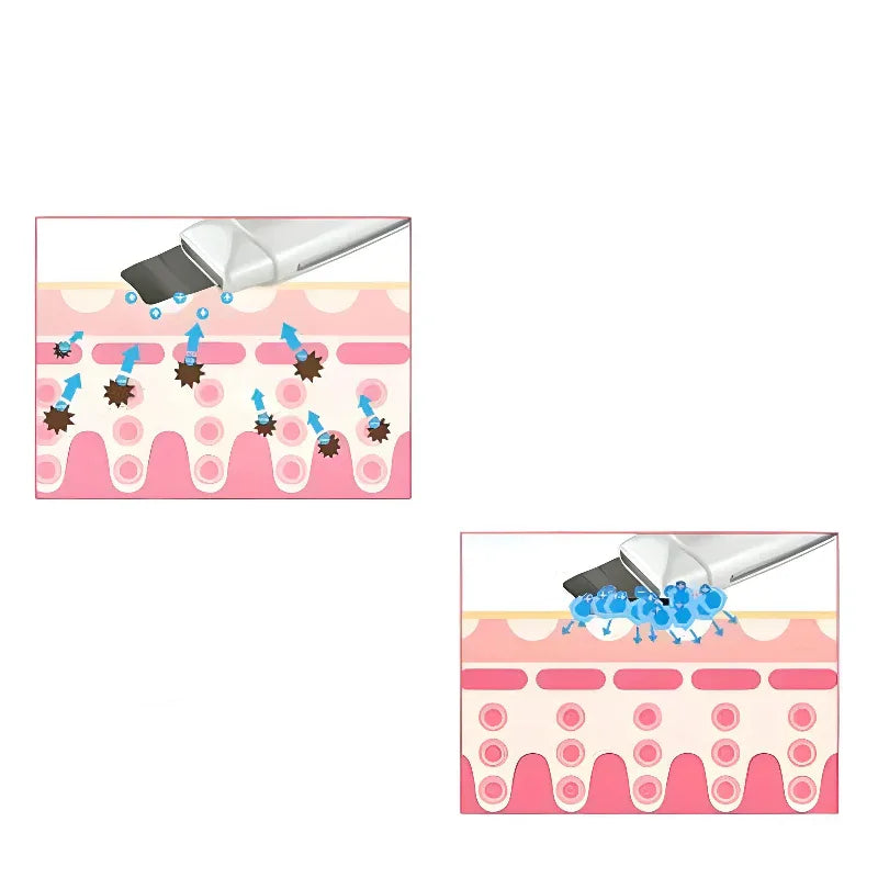 Ultrasonic Facial Skin Scrubber Cleanser Blackhead Acne Removal Facial Spa Vibration Massager Ultrasound Peeling Beauty Device