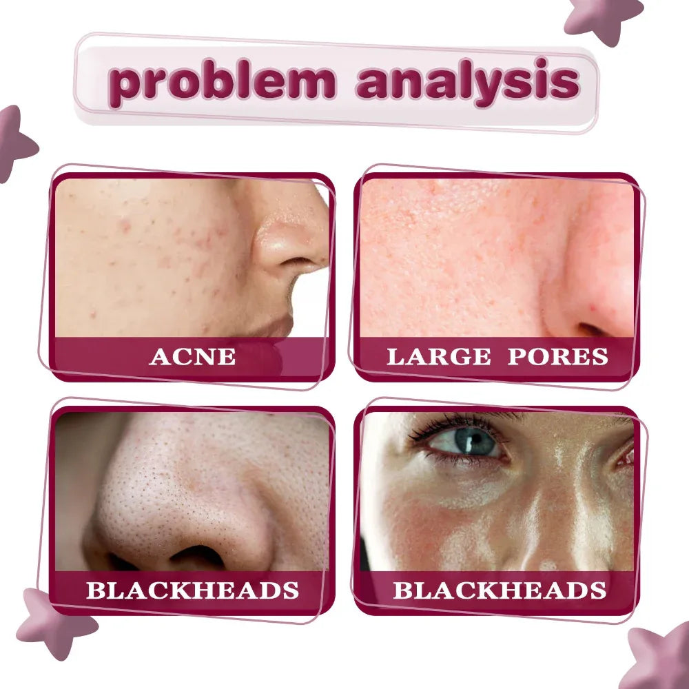 Tartaric Acid Blackhead Removing Acne Smallpox Diluting Brightening Skin Care Serum Acid Essence